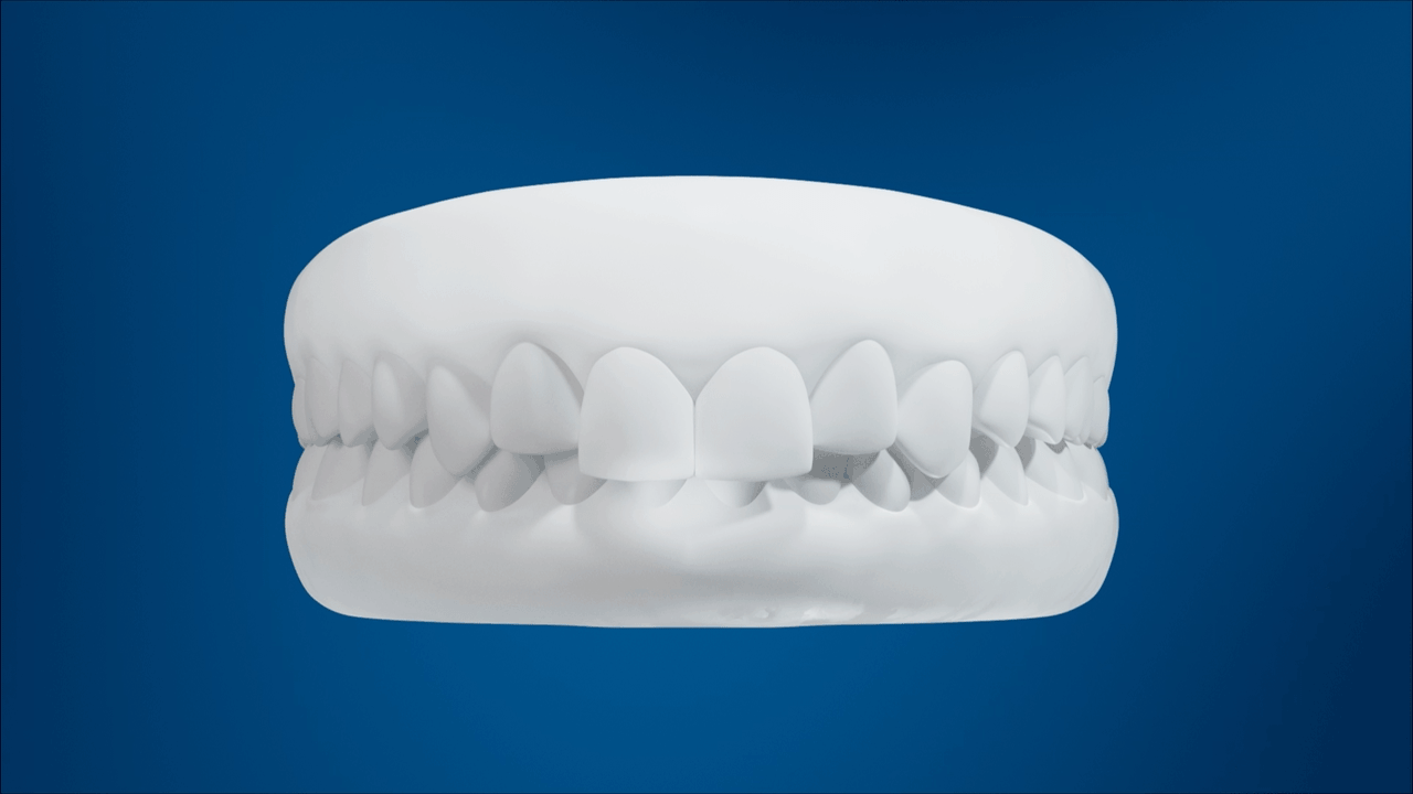 Overbite-Front-Animation